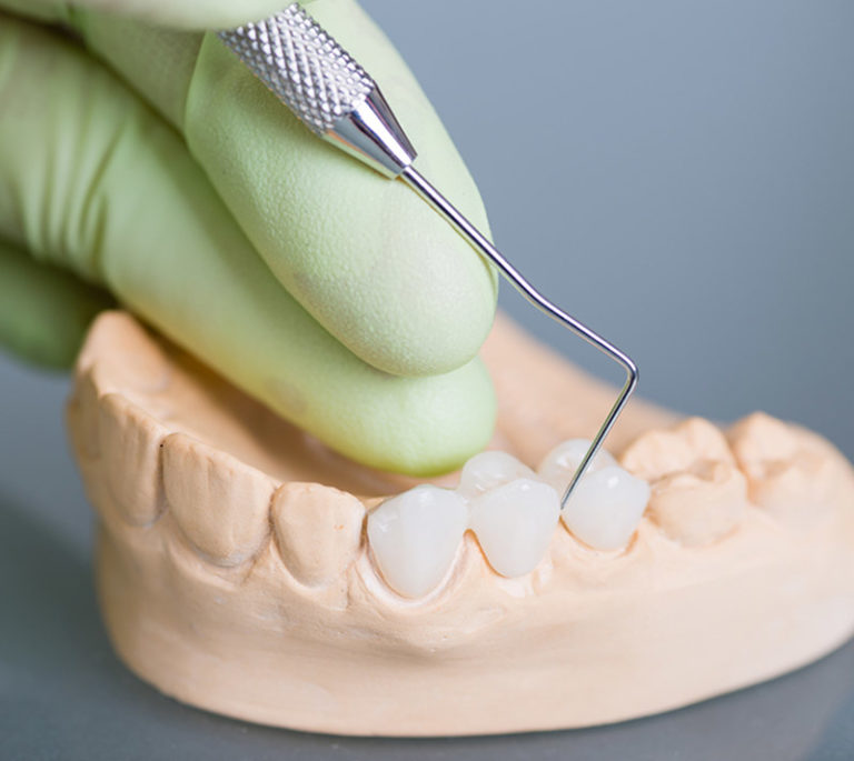 dental crowns demo
