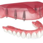 dental implants in Duncan
