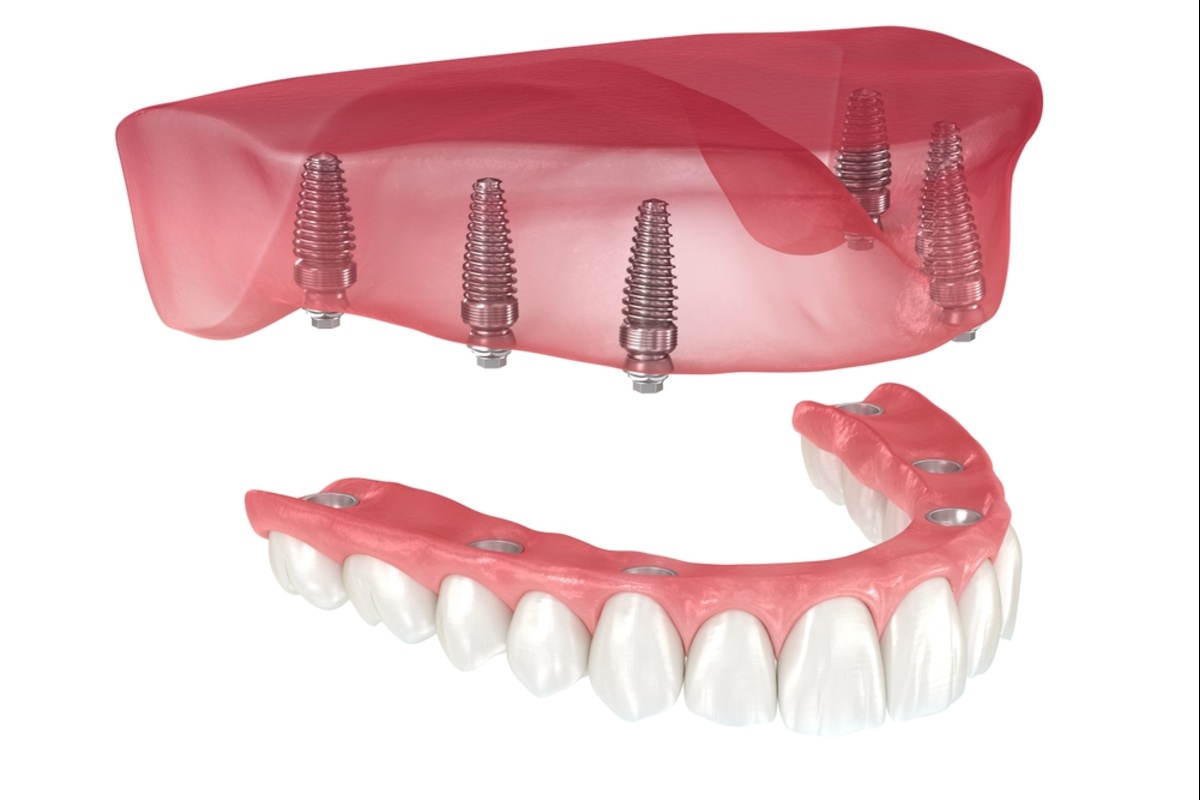 dental implants in Duncan