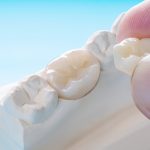 dental crowns in duncan