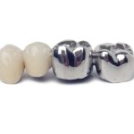 dental crowns porcelain vs metal