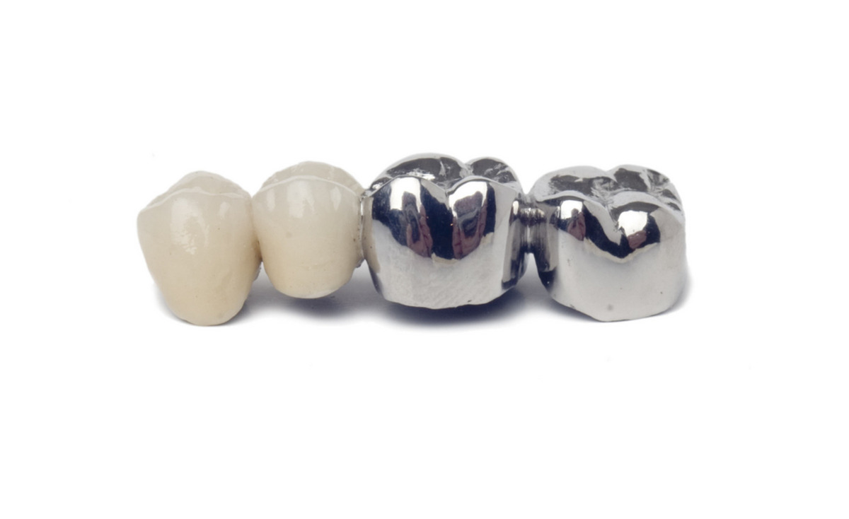 dental crowns porcelain vs metal
