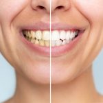 teeth whitening