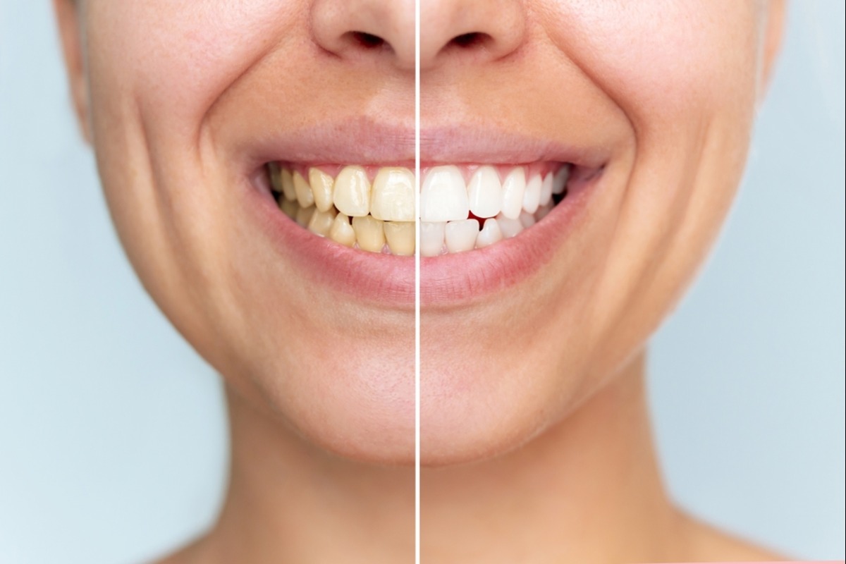 teeth whitening