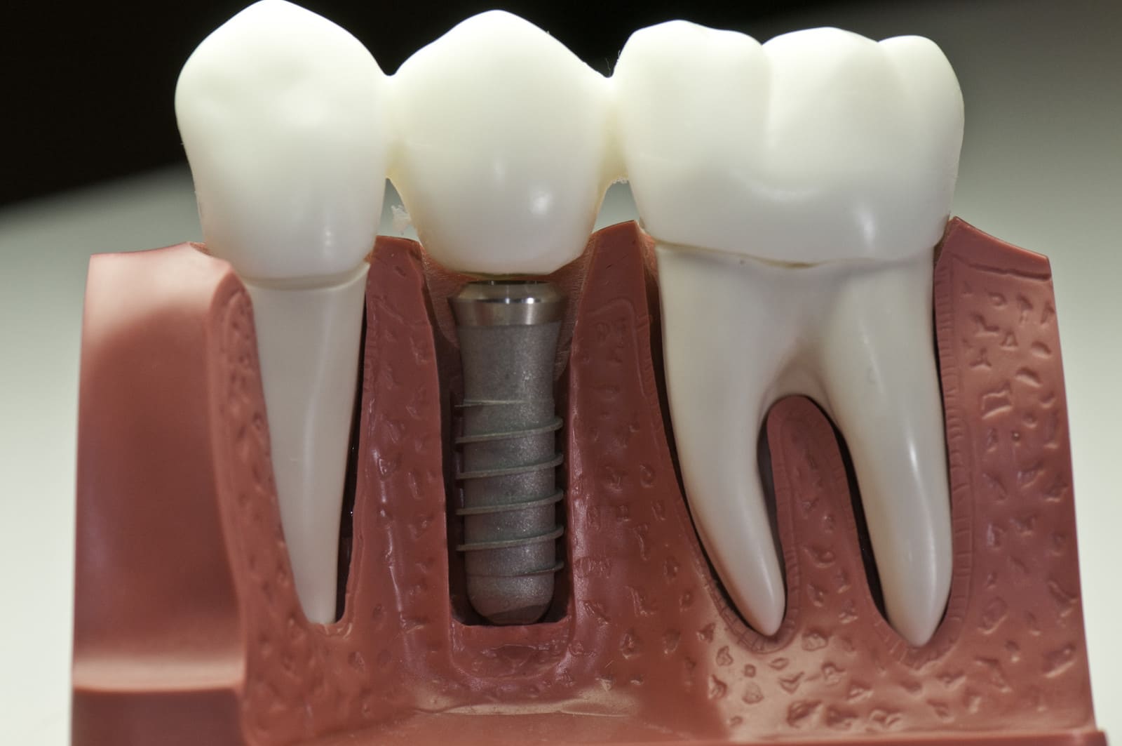 Dental Implants: Procedure, Risks, and Types