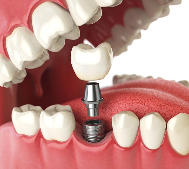 dental implants in duncan