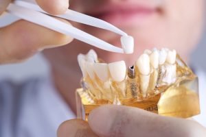 Hygiene Care After Dental Implants