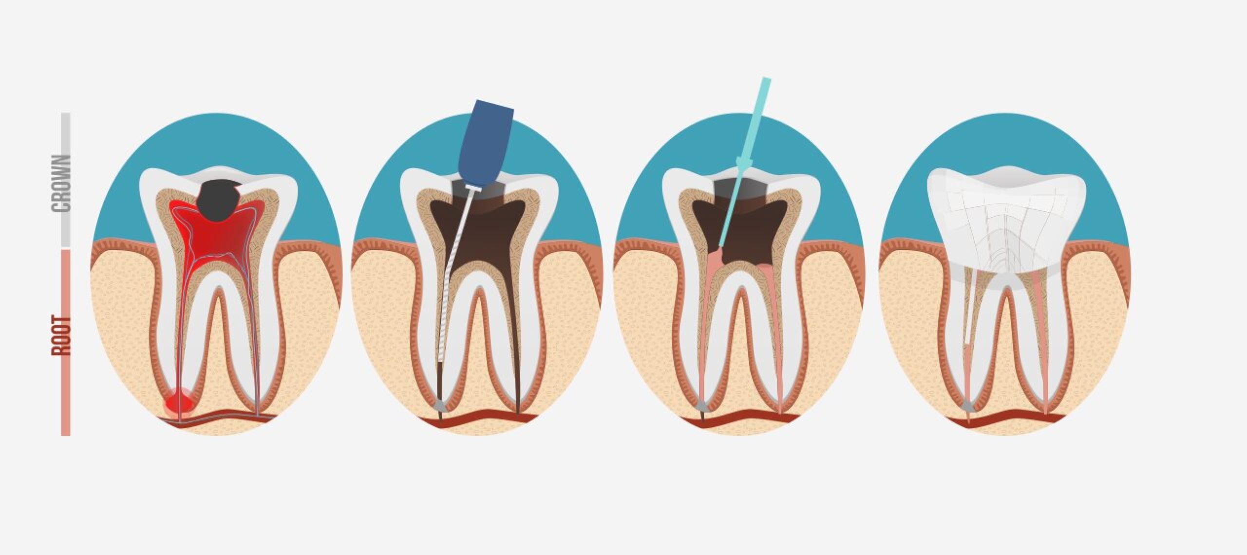 speeding up recovery after root canal therapy how to heal quickly