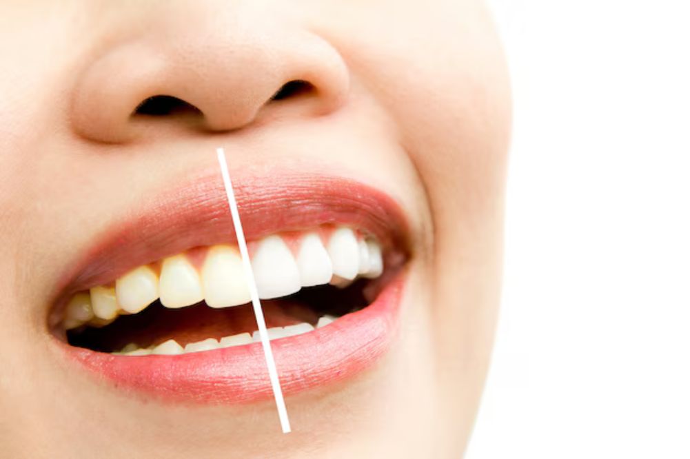 before and after teeth whitening