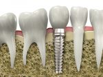 what you need to know about the cost of dental implants